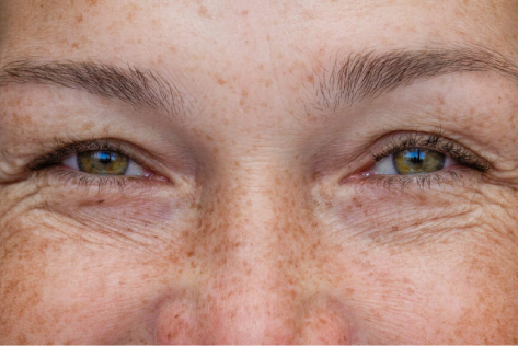 What's the Difference Between Fine Lines and Wrinkles?